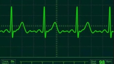ECG Dynamic HeatlhBar